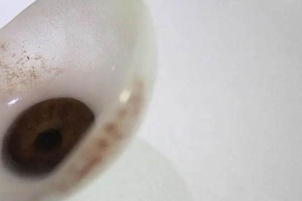 装有义眼对脑CT有影响吗